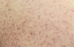 Cô gái 21 tuổi suýt mất mạng vì sốc sốt xuất huyết Dengue nặng