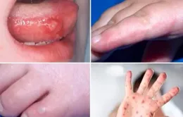Hải Dương: Tăng ca tay chân miệng, cảnh báo biến chứng do điều trị tại nhà kéo dài