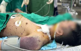 Biến chứng thủy đậu nguy kịch: Một ca xin về, một ca vẫn thở máy