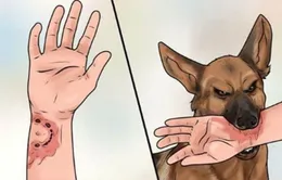Bé trai mắc bệnh dại sau vết cắn tưởng đã lành