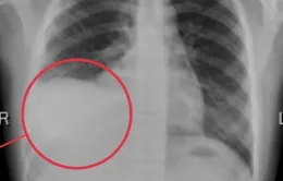 Cảnh báo tràn dịch màng phổi ở trẻ: Nguy hiểm nếu chậm phát hiện
