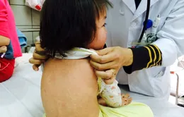 Cách phân biệt Sởi với sốt phát ban