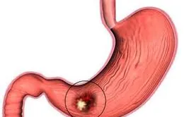 Viêm loét dạ dày - tá tràng cần chữa trị dứt điểm