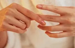 Đề phòng viêm khớp dạng thấp giai đoạn cấp tính
