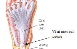 Không nên đi lại nhiều khi bị gai xương bàn chân