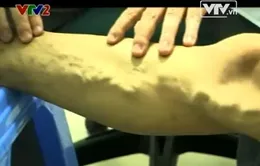 80% bệnh nhân giãn tĩnh mạch chân không biết mình mắc bệnh