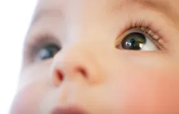 Sởi có thể gây biến chứng khô mắt