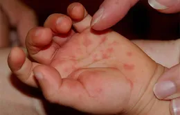 Thời điểm nào dễ xuất hiện bệnh Tay chân miệng?