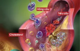 Lưu ý cho bệnh nhân rối loạn mỡ máu
