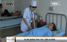 Hy hữu bà cụ mang thai “đá” gần 30 năm