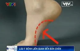 Lưu ý bệnh gai xương bàn chân