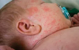 Cách chăm sóc trẻ mắc sởi tại nhà