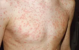 Các bệnh sốt phát ban: Dễ nhầm lẫn!