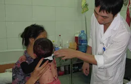 Nguyên nhân bùng phát bệnh thủy đậu