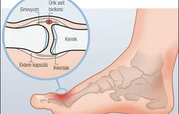 Phương pháp mới điều trị bệnh gút