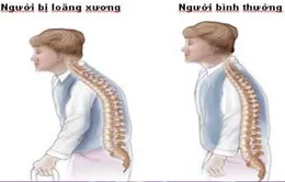 Phát hiện và phòng ngừa bệnh loãng xương ở phụ nữ