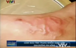 Cảnh báo bệnh nguy hiểm: Giun lươn bò dưới da 