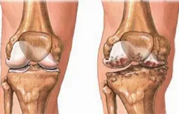 Sử dụng thuốc điều trị khớp đúng cách