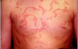 Dị ứng và biện pháp phòng tránh