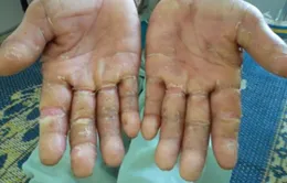 Đề nghị cấp gạo mới cho dân vùng “bệnh lạ”