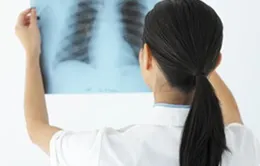 Nguy hiểm bệnh lao đa kháng thuốc