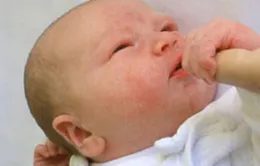 Những lưu ý chăm sóc trẻ bị chàm sữa