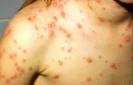 Mùa của bệnh thủy đậu