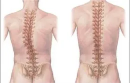 Giải pháp nào cho trẻ vẹo cột sống?