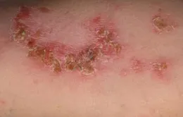 Bệnh chốc dùng thuốc gì?