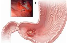 Diệt vi khuẩn H. Pylory - Thuốc gì?