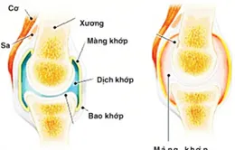 Dùng methotrexat điều trị thấp khớp cho đúng