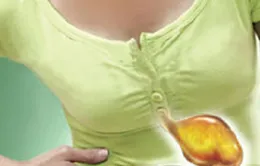 Trào ngược dạ dày thực quản