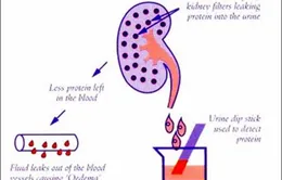 Sử dụng kéo dài steroid trong điều trị bệnh thận ở trẻ em: Lợi hay hại?