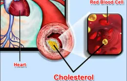 Thận trọng với thuốc hạ mỡ máu nhóm statin