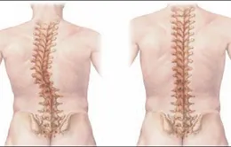 Phát hiện sớm chứng vẹo cột sống ở trẻ em
