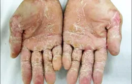 Quảng Ngãi tăng cường công tác phòng chống “bệnh lạ”