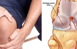 Bệnh khớp gối - Chớ coi thường!