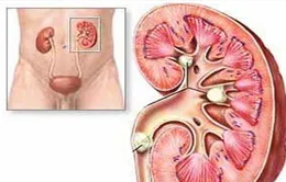 Bài thuốc Đông y điều trị hiệu quả bệnh sỏi thận