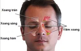Các bệnh dị ứng và cách điều trị viêm mũi dị ứng