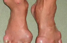 Bài thuốc điều trị hiệu quả bệnh Gout
