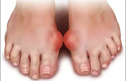 Bệnh Gout: Đâu là nguyên nhân?