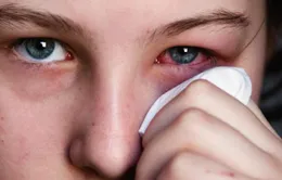 Những lưu ý khi bị đau mắt đỏ