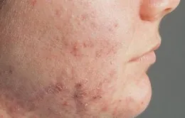 Điều trị bệnh viêm da dị ứng trong tiết giao mùa