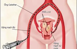 Vì sao phụ nữ dễ bị u xơ tử cung?