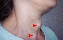 I ốt - Vi chất quan trọng để cơ thể khỏe mạnh