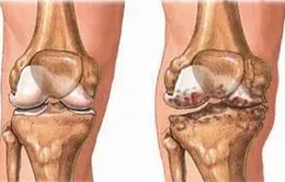 Phẫu thuật điều trị thoái hóa khớp, khi nào thì nên?