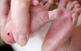 Nâng cao chất lượng dân số bằng sàng lọc, chẩn đoán trước sinh và sơ sinh 