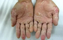 Gạo ủ là nguyên nhân gây “bệnh lạ” ở Quảng Ngãi