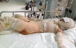 Xót xa cháu bé bỏng nặng lấy da vá da