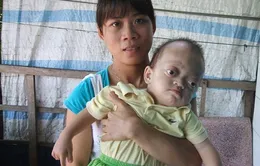 Xót thương bé mắc bệnh “lồi mắt” hiếm gặp